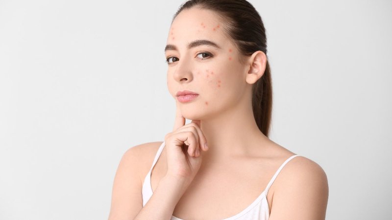 Qual é o Seu Tipo de Acne? Hormonal, Inflamatória, Adulta ou Emocional