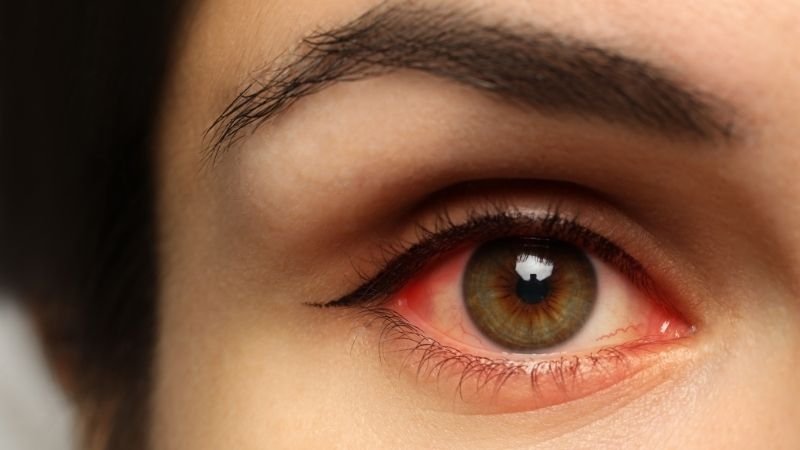 Alergia Ocular Tem Cura? O Que Diz a Medicina