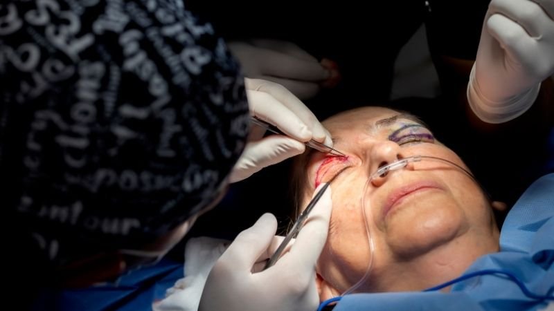 Calázio Precisa de Cirurgia? Quando o Procedimento é Indicado