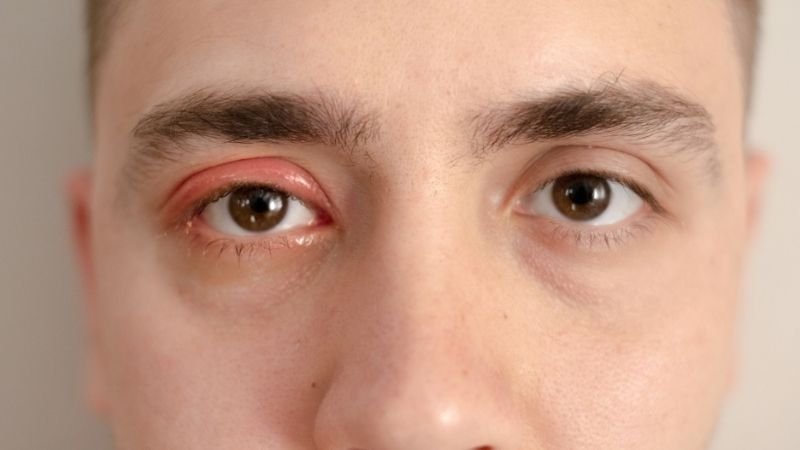 Terçol Recorrente: O Que Pode Estar Por Trás do Problema