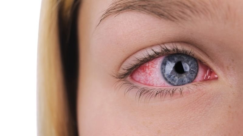 Infecção Ocular é Grave? Sintomas que Indicam Emergência