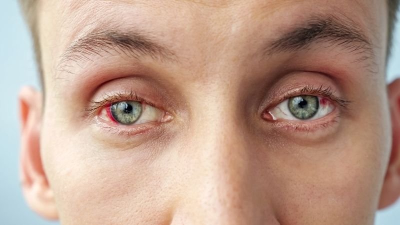 🔴 Olho Vermelho com Dor: Pode Ser Infecção?