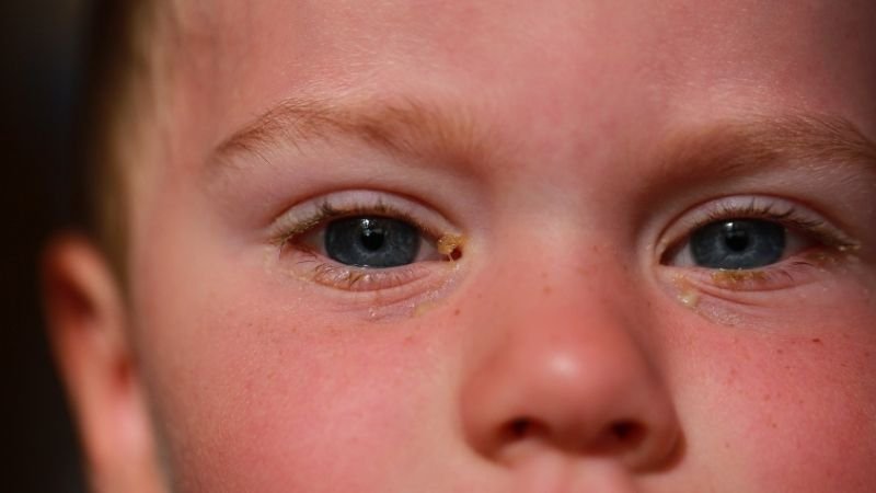 🔴 Olhos Vermelhos em Crianças: Quando Levar ao Médico